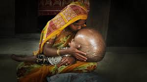 Roona Begum and her mother sit inside their house. This is the picture of them that went viral, leading to her getting treatment.